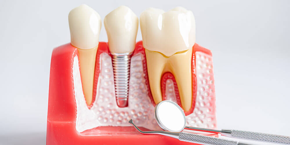 Dental Implants Lloydminster