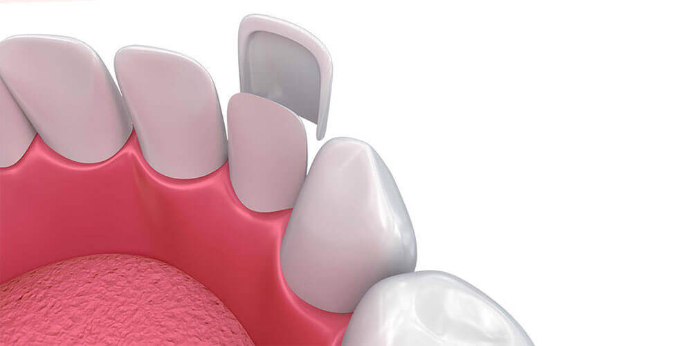Dental veneers smile makeover in Lloydminster